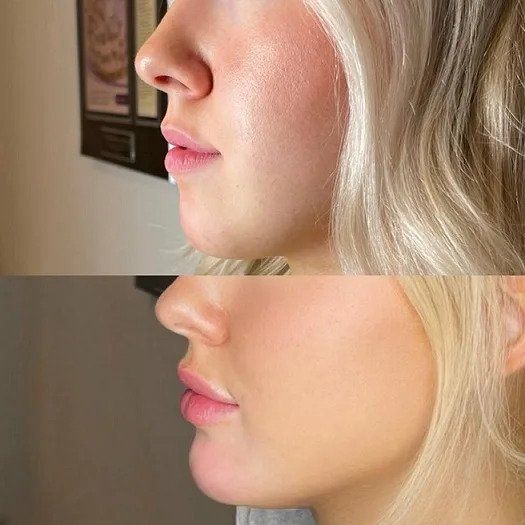 Navigating the Consultation: What to Ask at the Best Aesthetic Clinic in dubai for Chin Fillers