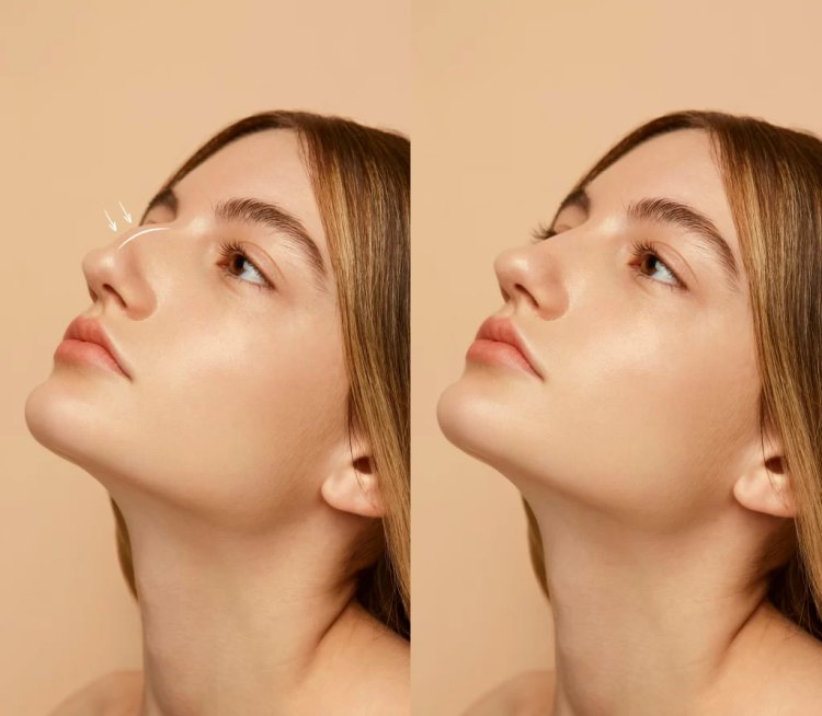 Nose Job Chicago: Expert Rhinoplasty for a Balanced, Beautiful