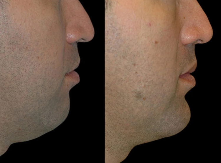 The Best Doctors in dubai for Chin Fillers: Enhance Your Confidence