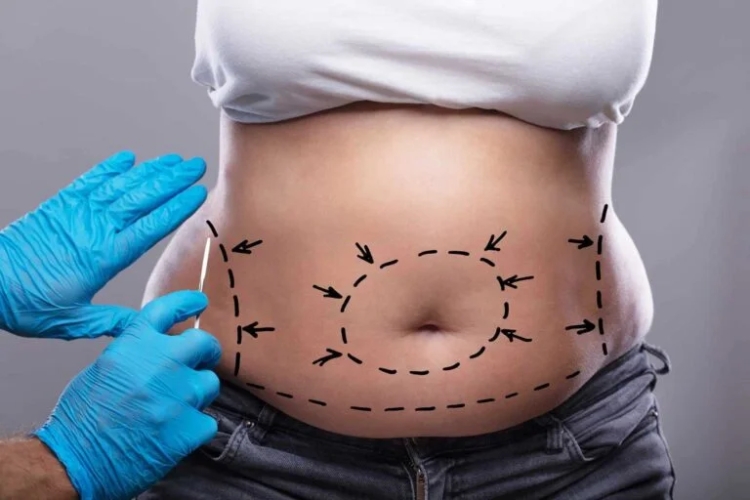 Tummy Tuck in Dubai: What to Expect During and After Your Surgery