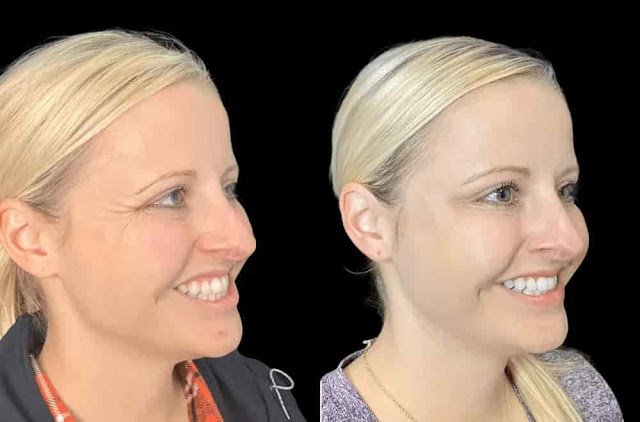 Botox Treatment in Dubai Safe, Effective, and Non-Invasive