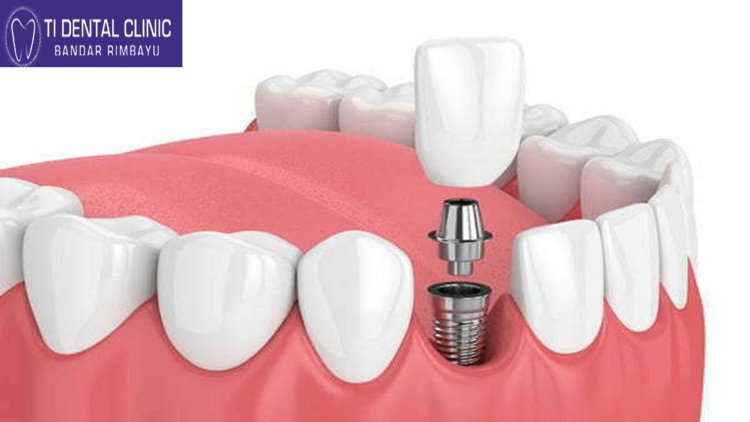 Need to Know About Dental Implants at Tidental