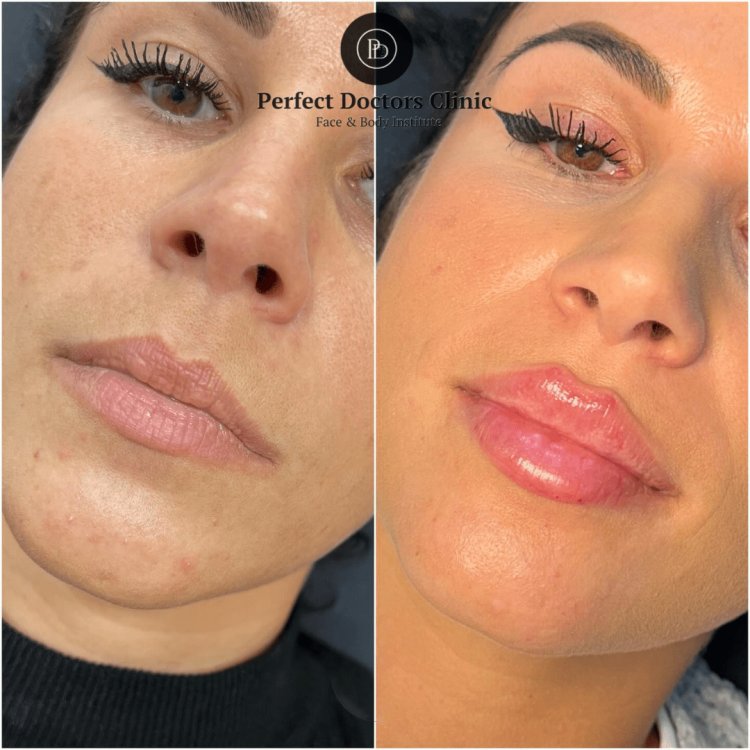Dermal Fillers for Men: Best Aesthetic Clinics in dubai for Masculine Enhancement