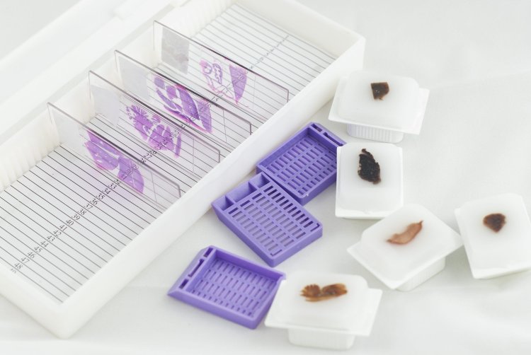 Unlocking the Potential of Cancer Tissue Blocks: A Comprehensive Guide