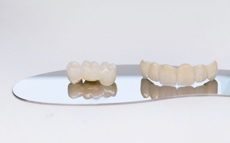 Dental Bridges - What Types of Dental Bridges Are Available?