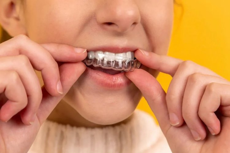 What You Should Know About Invisalign