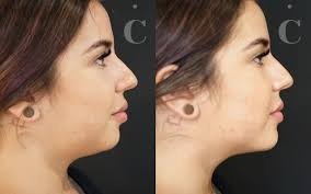 Jawline Filler Near Me: Elevate Your Profile with Precision Contouring