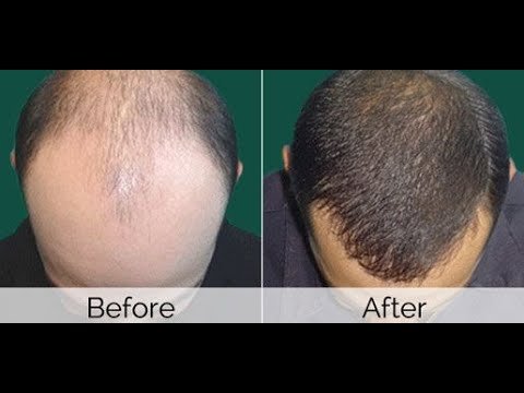 صور قبل وبعد لزراعة الشعر في دبي: كيف تغيرت حياة المرضى؟