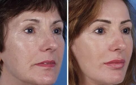 Sciton Contour TRL: A Revolutionary Approach to Skin Rejuvenation