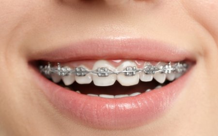 How Braces Can Improve Your Oral Health and Confidence