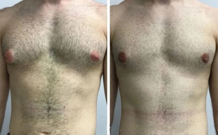 Patient Success Stories with the Best Doctors in Dubai for Gynecomastia