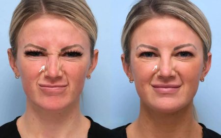 Botox Treatment in Dubai for Wrinkles: A Comprehensive Guide