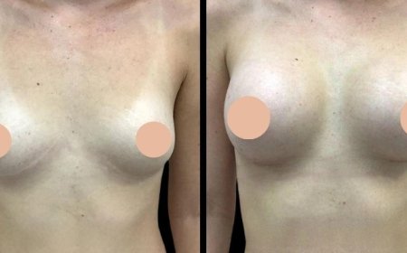 Best Breast Augmentation Surgeons in Dubai: Understanding the Risks and How to Minimize Them