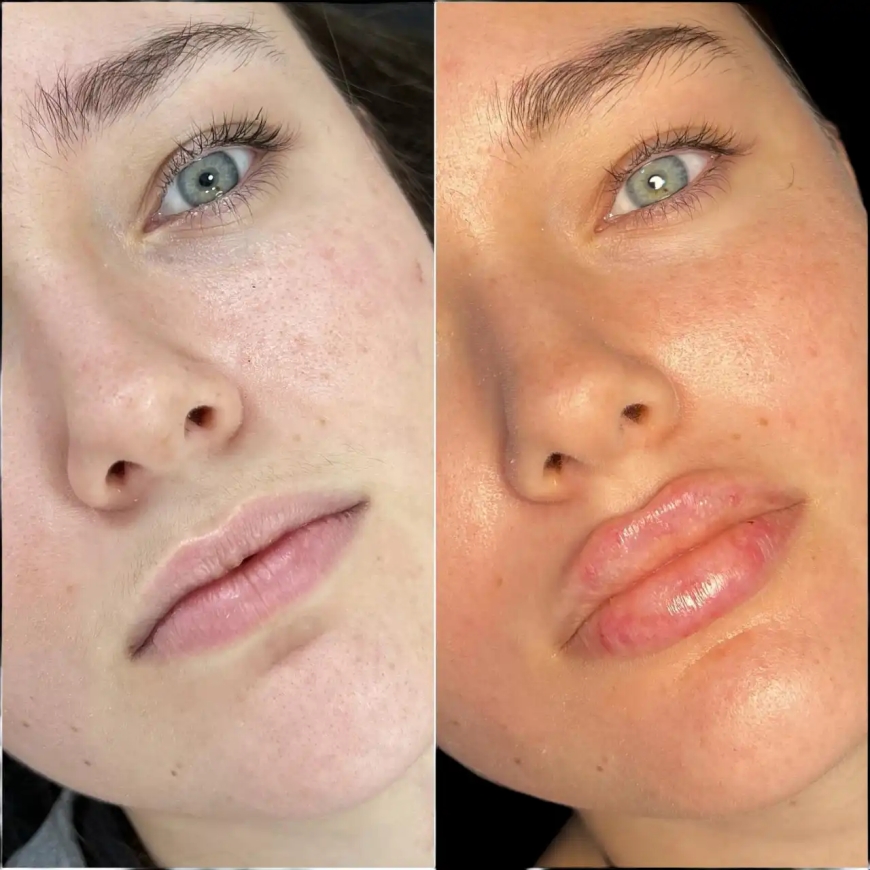 Best Aesthetic Clinic in dubai for Fillers: What You Should Know About Costs