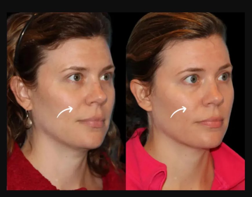 Avoid These Sculptra Fillers Mistakes: Advice from Best Aesthetic Clinic in Dubai