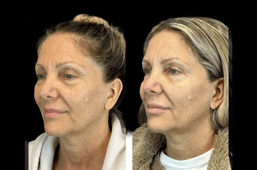Why the Best Aesthetic Clinics in dubai Are Botox Experts Too