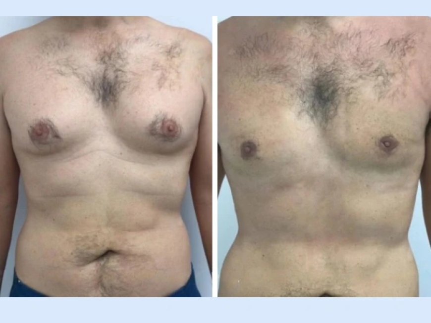 Understanding the Stages of Gynecomastia in Dubai