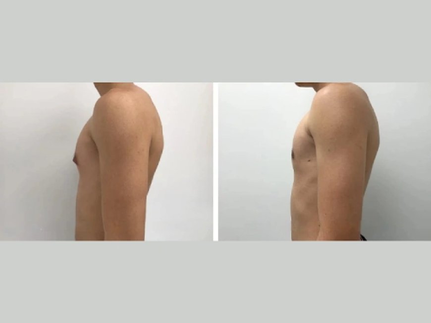 Best Post-Surgery Garments for Gynecomastia in Dubai
