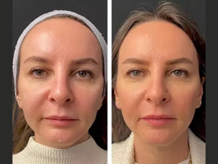 Mesotherapy in Dubai: The Ultimate Guide to Glowing Skin Treatments