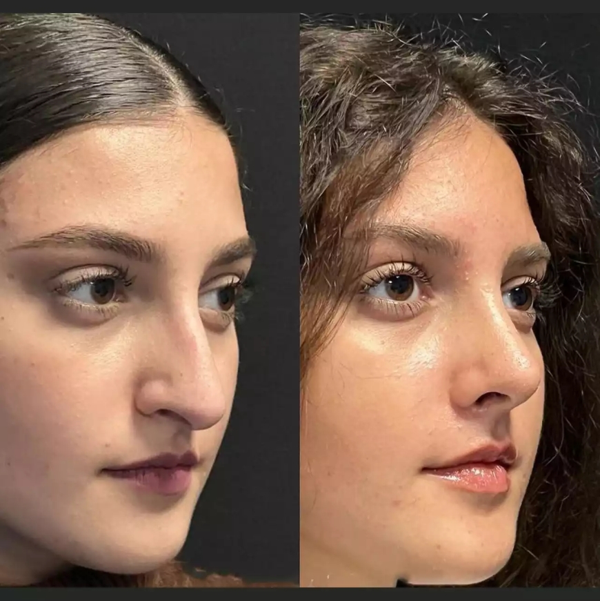 Septoplasty in Dubai: Who Performs the Procedure?