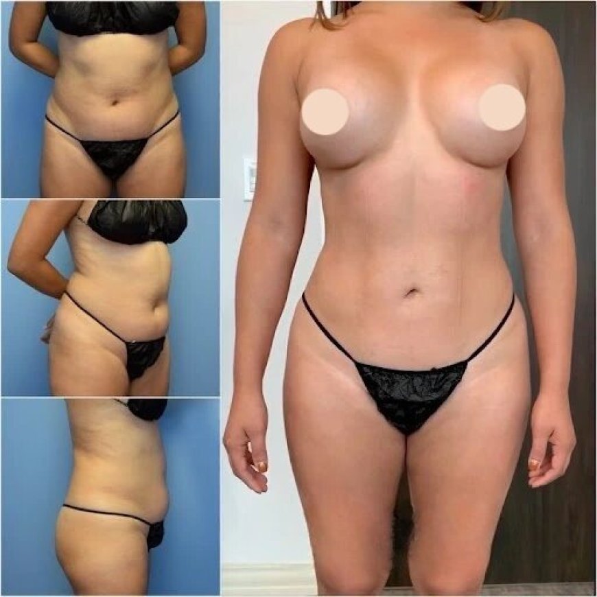 How Body Contouring in Dubai Helps Shape Your Body