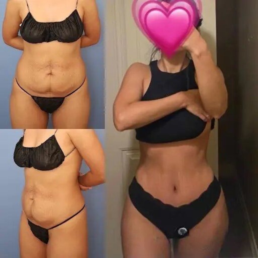 What Are the Benefits of Tummy Tuck in Dubai?