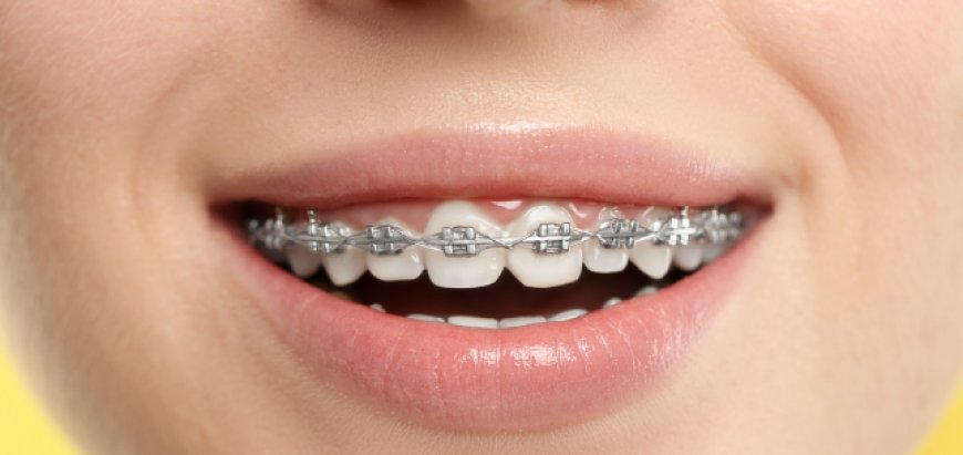How Braces Can Improve Your Oral Health and Confidence