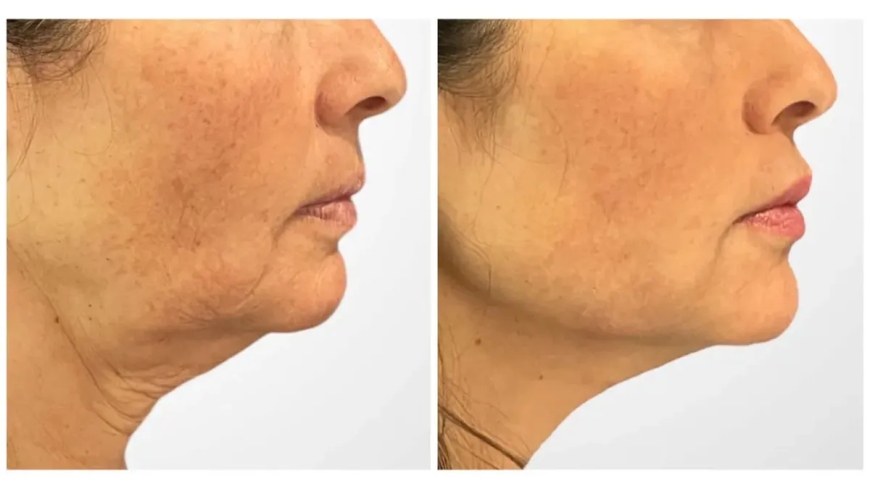 How Long Do Results Last? The Best Plastic Surgeon in Dubai Explains Thread Lift Longevity