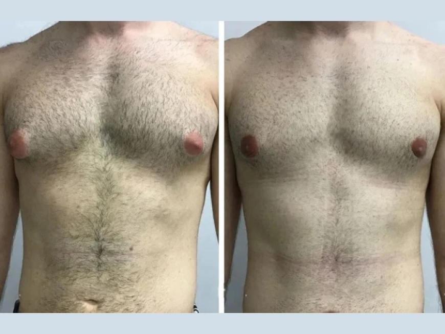 Things No One Tells You About the Best Gynecomastia Surgeon in Dubai