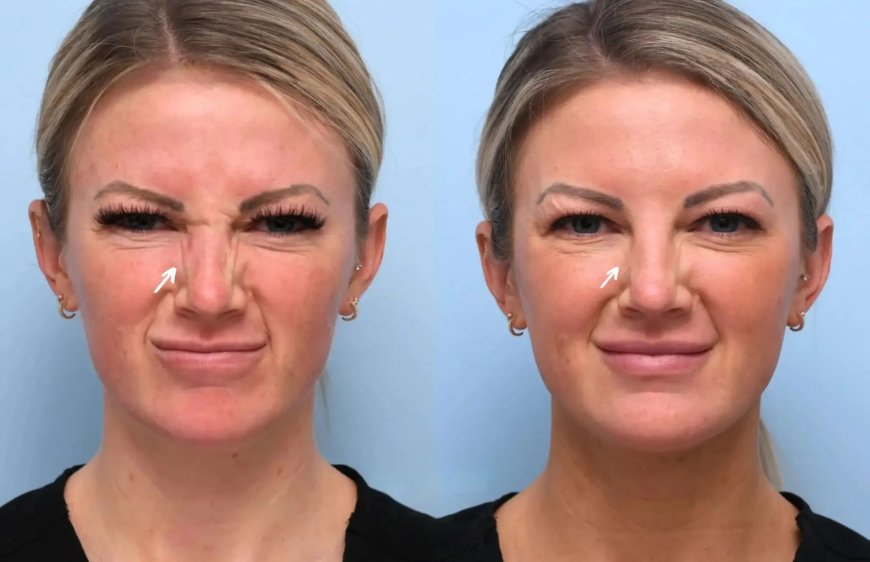 The Benefits of Botox Treatment in Dubai for Anti-Aging