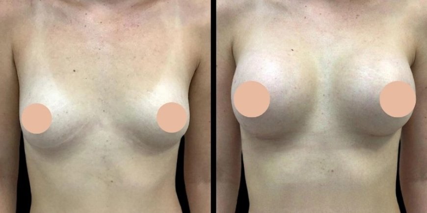Best Breast Augmentation Surgeons in Dubai: Understanding the Risks and How to Minimize Them