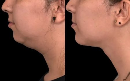 What Makes the Best Double Chin Removal Surgeons in Dubai Stand Out?