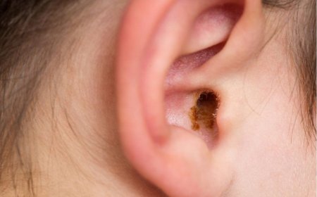 Is Pharmacy Earwax Removal Safe? Here’s What You Need to Know