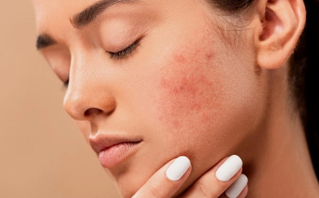 Why Isotroin Is the Go-To Treatment for Severe Acne