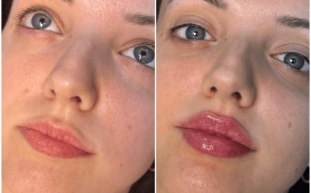 Time-Lapse: Healing After Juvederm in Dubai