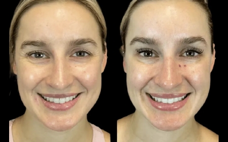 Inside the Botox Journey: What to Expect with the Best Plastic Surgeon in dubai