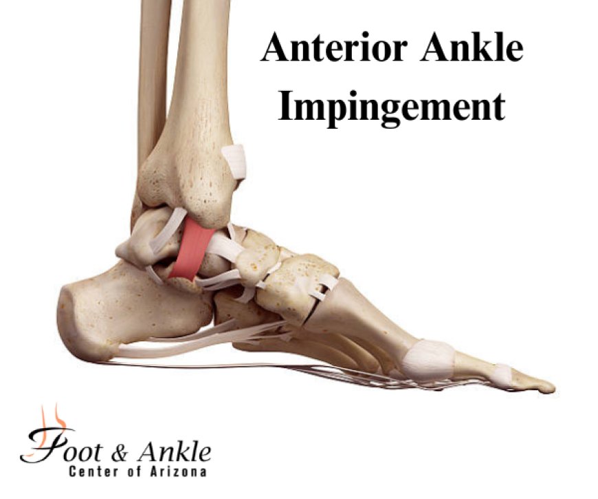 Anterior Ankle Impingement: Expert Tips for Fast Relief