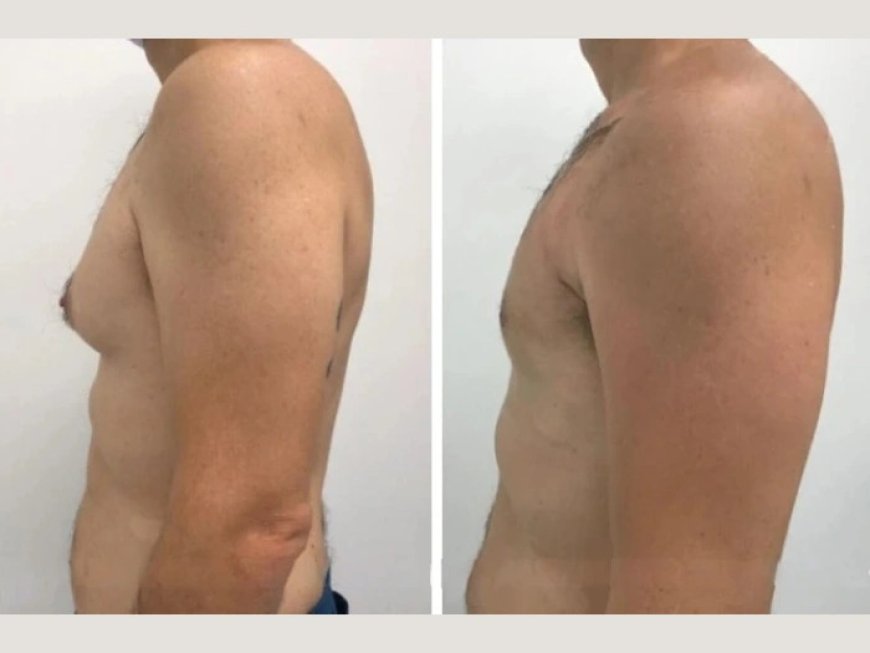 What You Should Know About Gynecomastia Surgery Costs in dubai