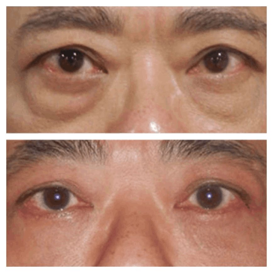 The Role of Technology in Eye Bag Removal Surgery with the Best Eye bag removal Surgeons in Dubai