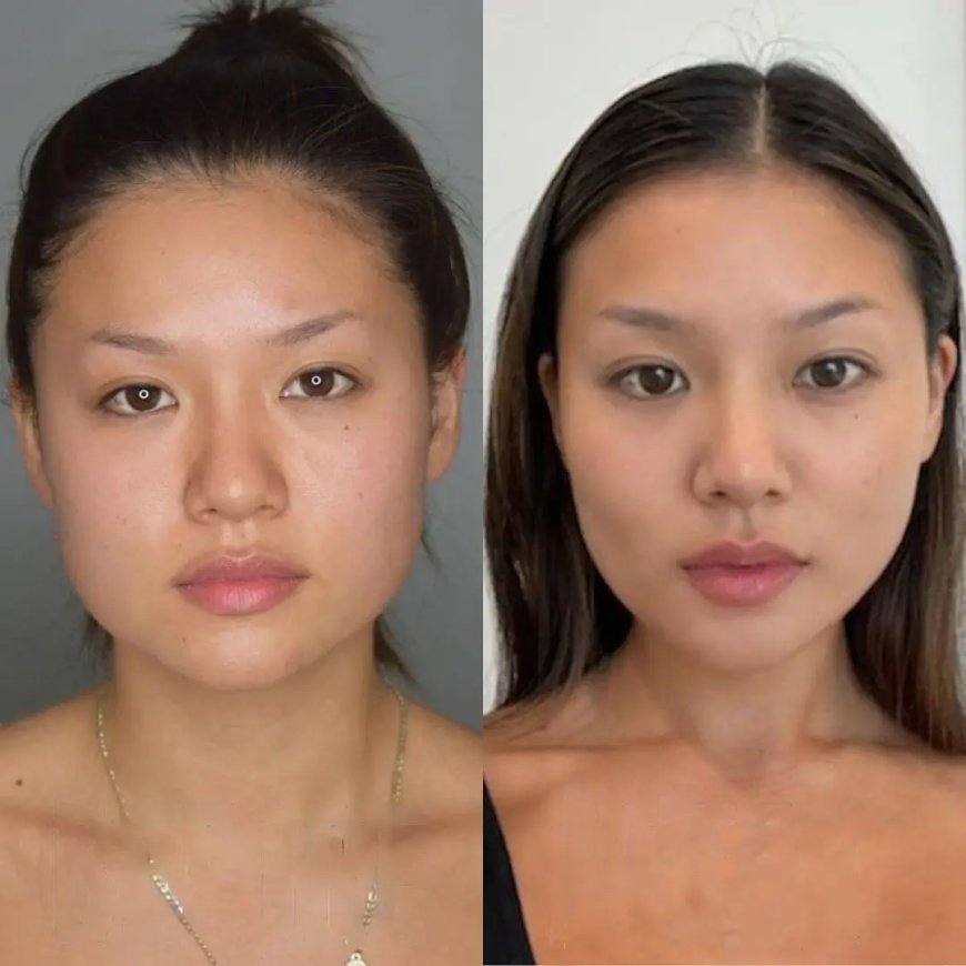 Do’s and Don’ts from the Best Buccal fat removal Surgeons in Dubai