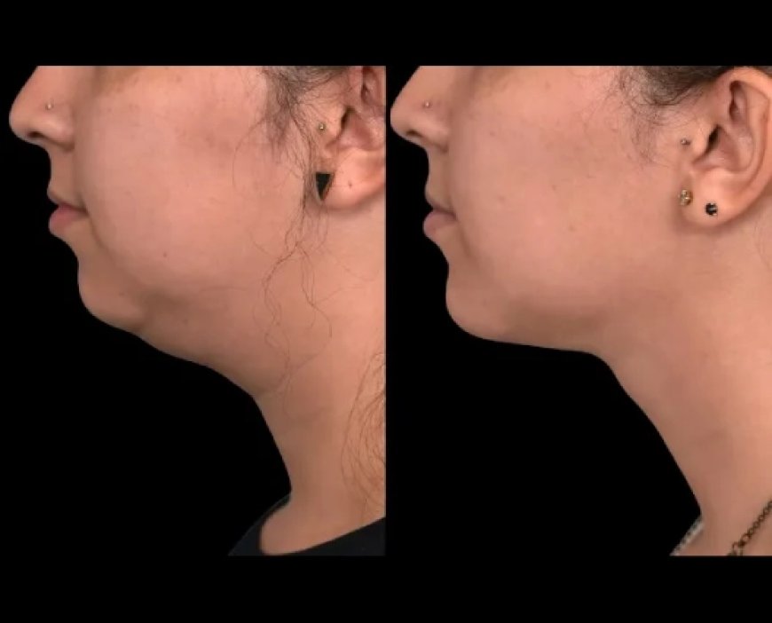 What Makes the Best Double Chin Removal Surgeons in Dubai Stand Out?