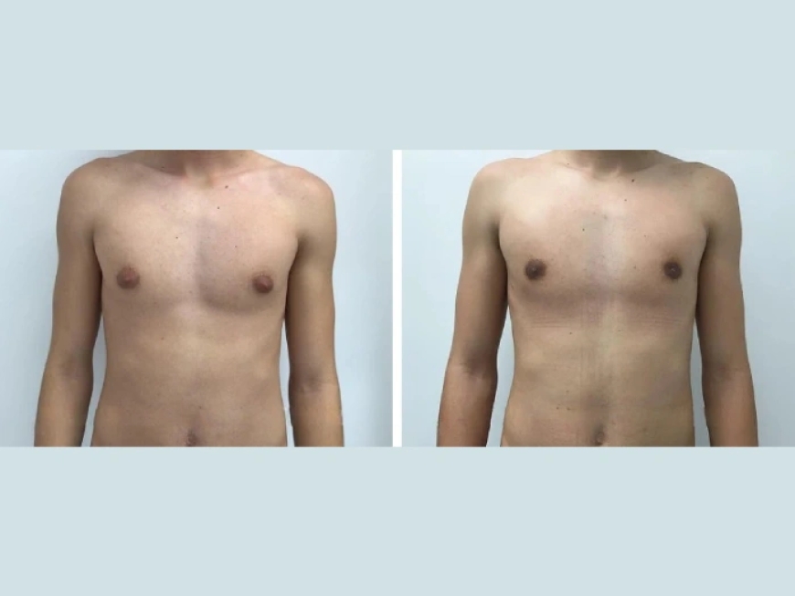 What Makes the Best Gynecomastia Surgeons in Dubai the Best Choice for Your Treatment