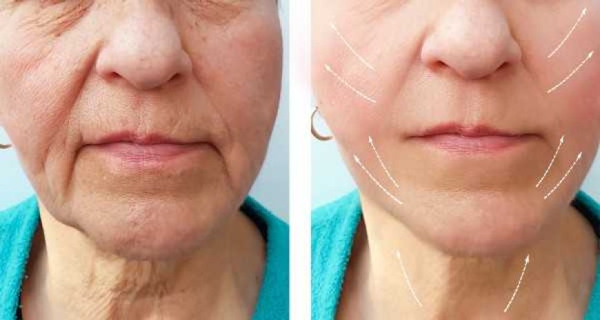 The Botox Journey Brings Noticeable Changes with Patience