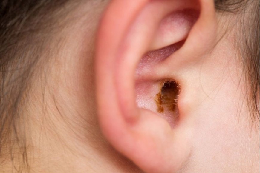 Is Pharmacy Earwax Removal Safe? Here’s What You Need to Know