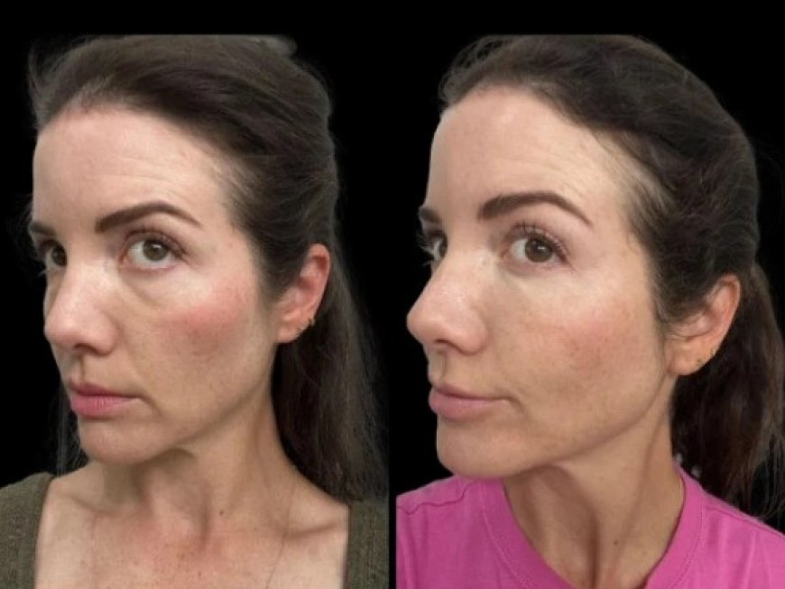 Dark Circles Treatments in Dubai: What to Expect During Your First Consultation