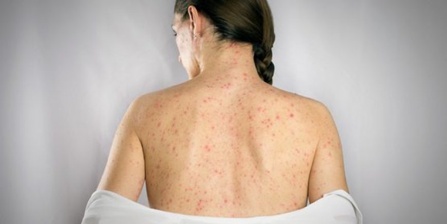 Doxycycline 100mg Capsule: Your Ally Against Syphilis Infections