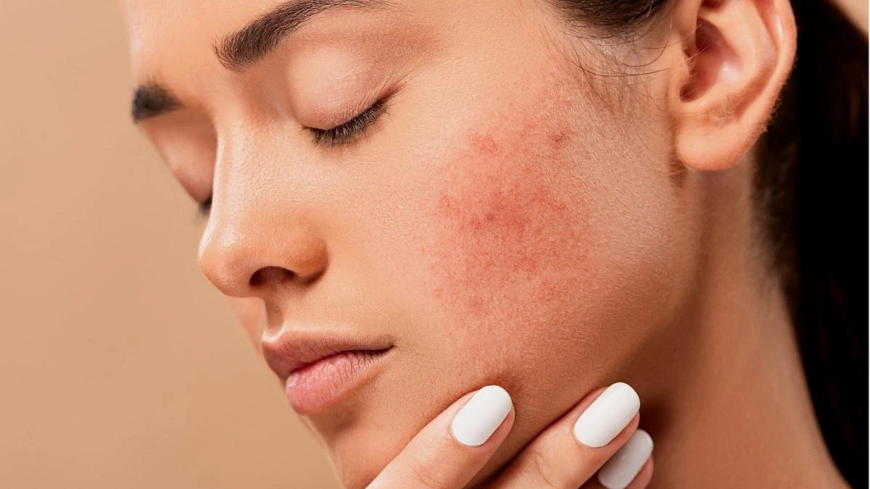 Why Isotroin Is the Go-To Treatment for Severe Acne