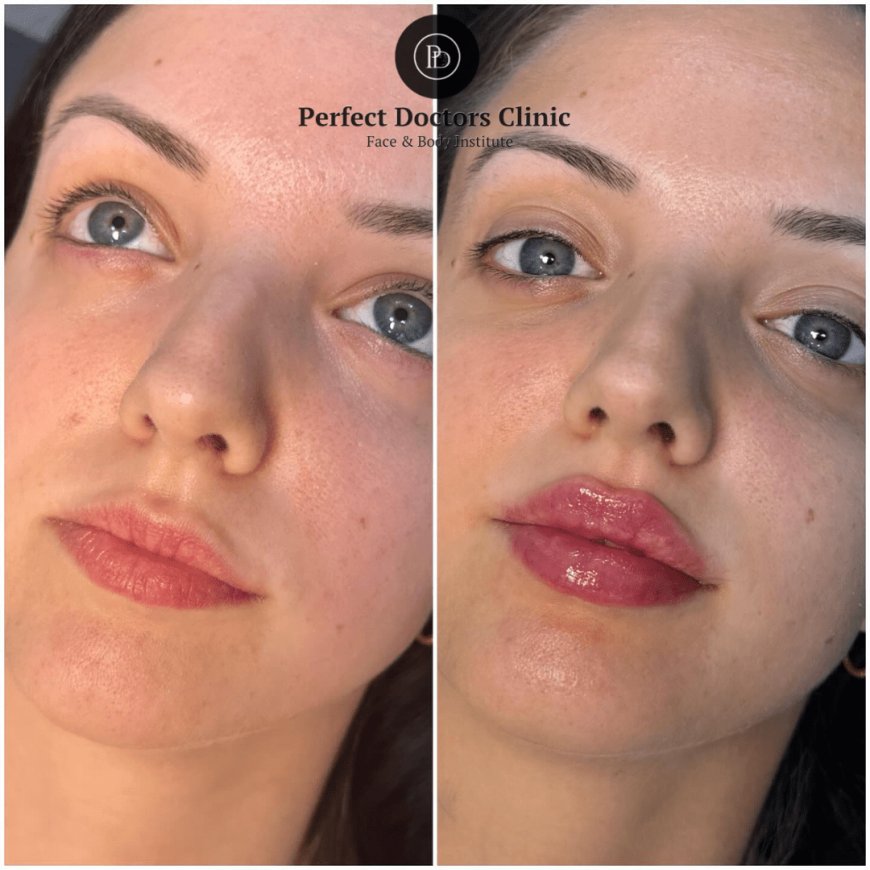 Time-Lapse: Healing After Juvederm in Dubai
