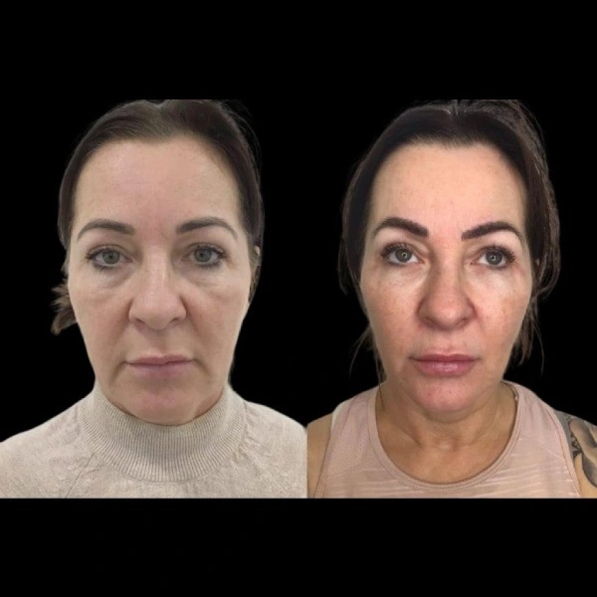 Best Plastic Surgeon in Dubai for Profhilo: Why Expertise Matters