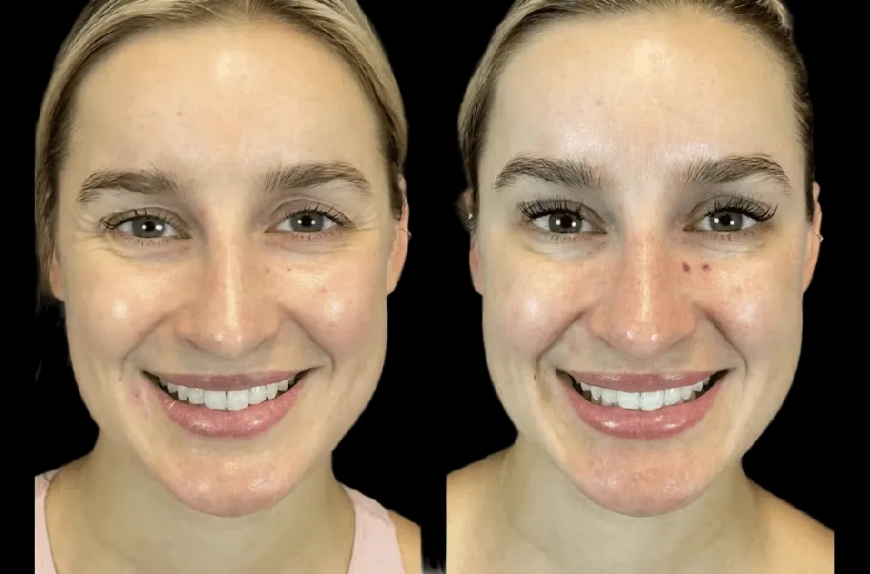 Inside the Botox Journey: What to Expect with the Best Plastic Surgeon in dubai
